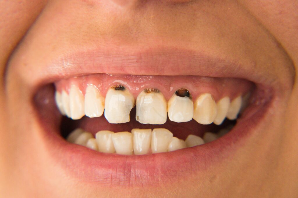 Harlan Dentist white tooth colored fillings