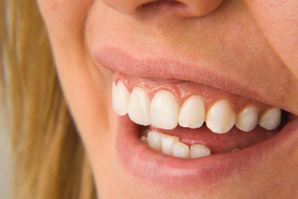 Teeth with composite tooth colored fillings