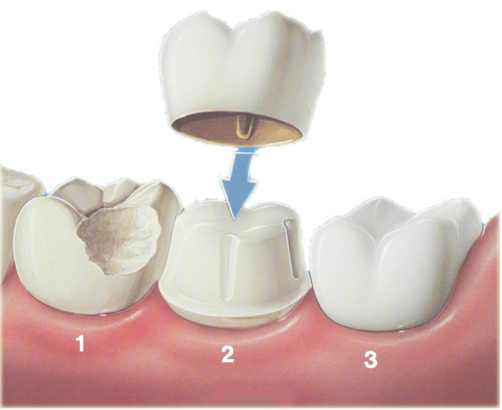 Dental crown