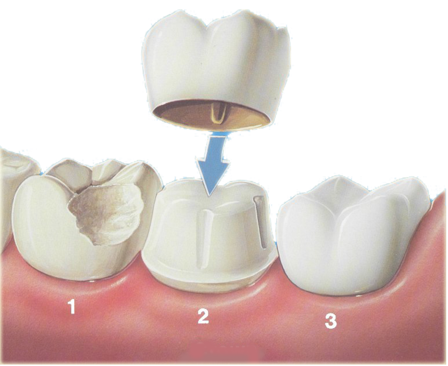 crowns-and-bridges-cornerstone-dental