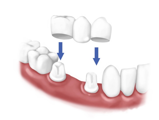 Dental bridge